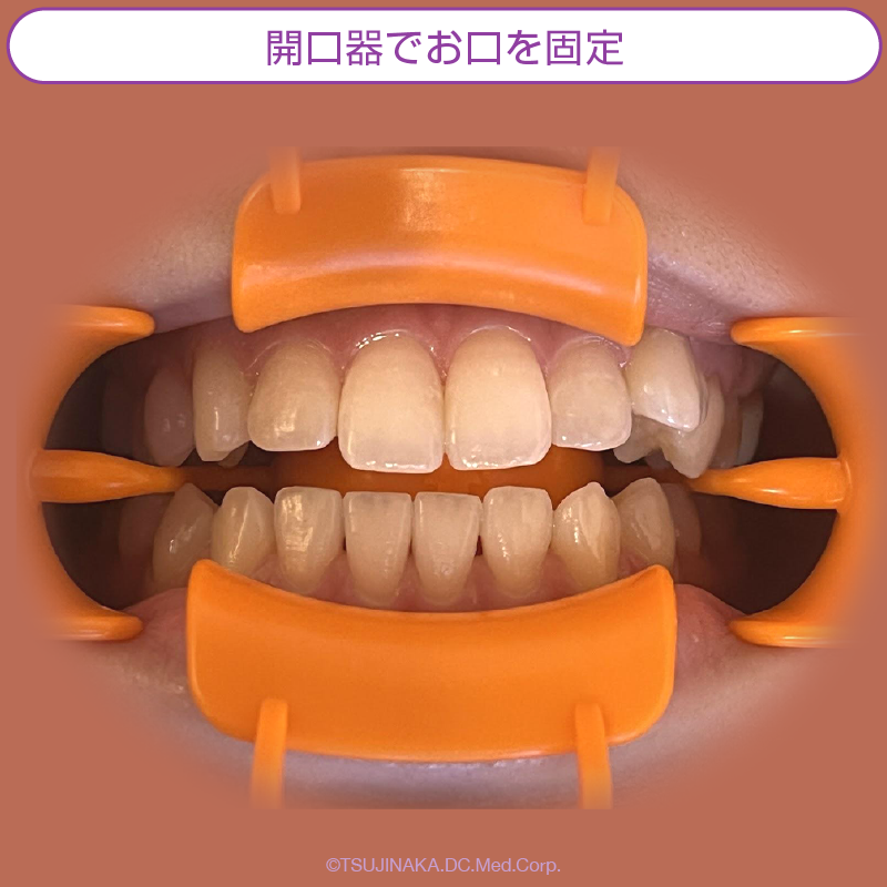 開口器でお口を固定