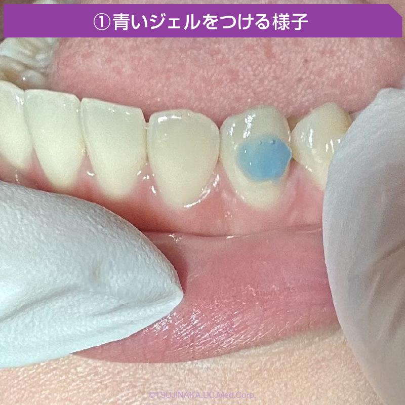 ①青いジェルをつける様子