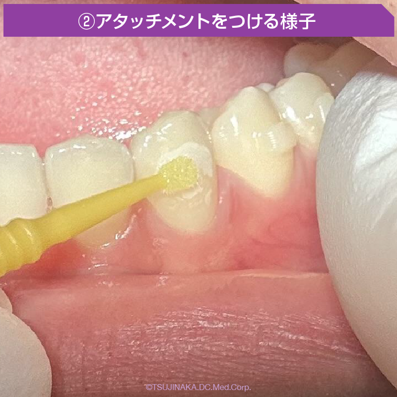 ②アタッチメントをつける様子
