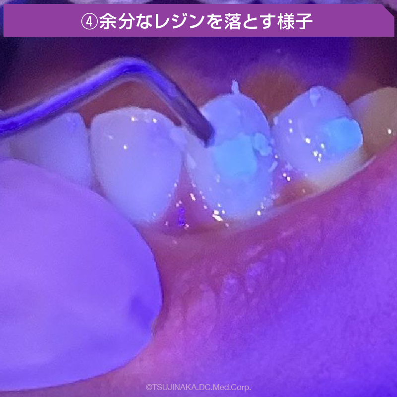 ④余分なレジンを落とす様子