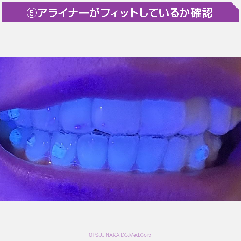 ⑤アライナーがフィットしているか確認
