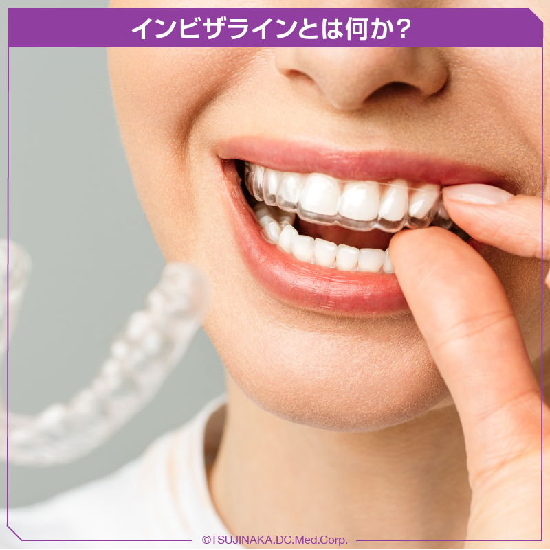 インビザラインとは何か？