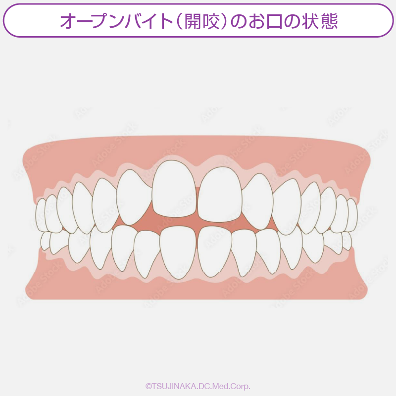 オープンバイト（開咬）のお口の状態