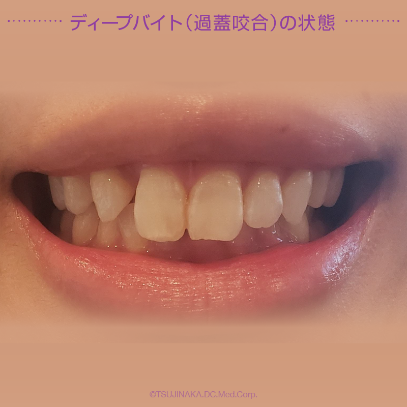 ディープバイト（過蓋咬合）の状態