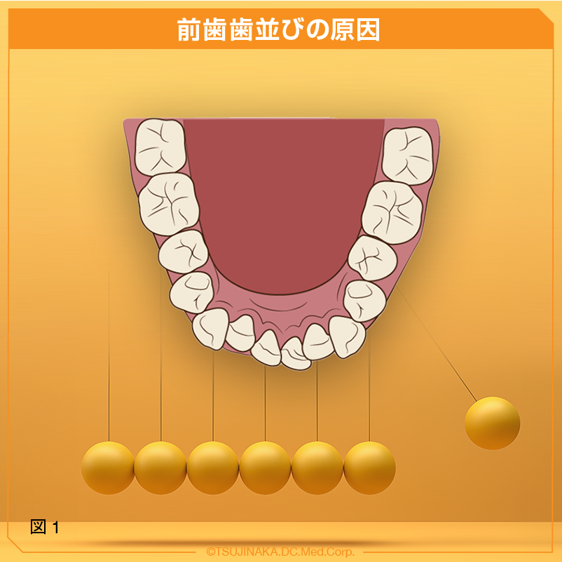前歯歯並びの原因