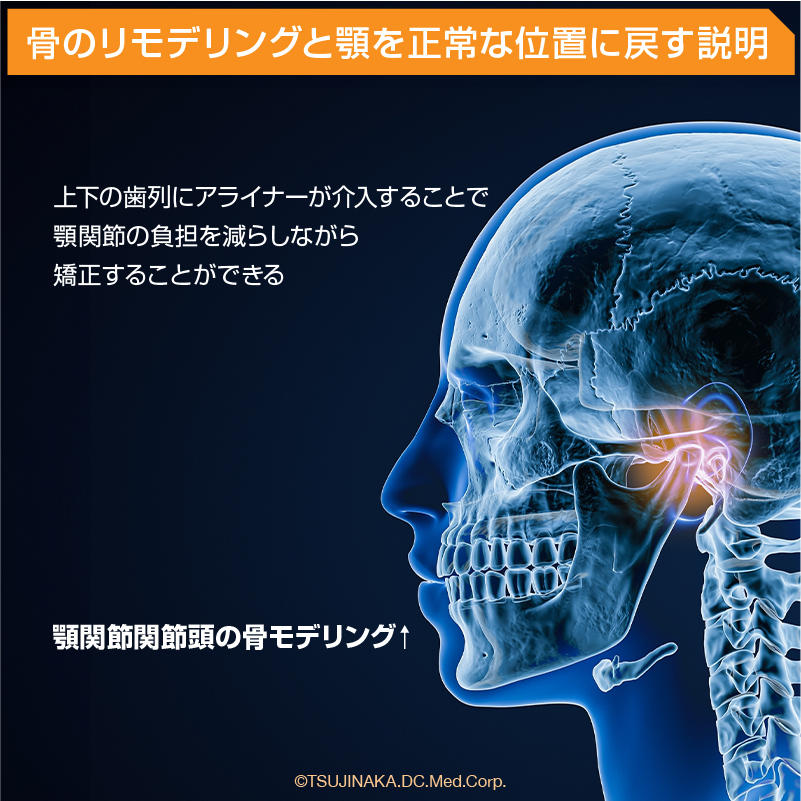 骨のリモデリングと顎を正常な位置に戻す説明