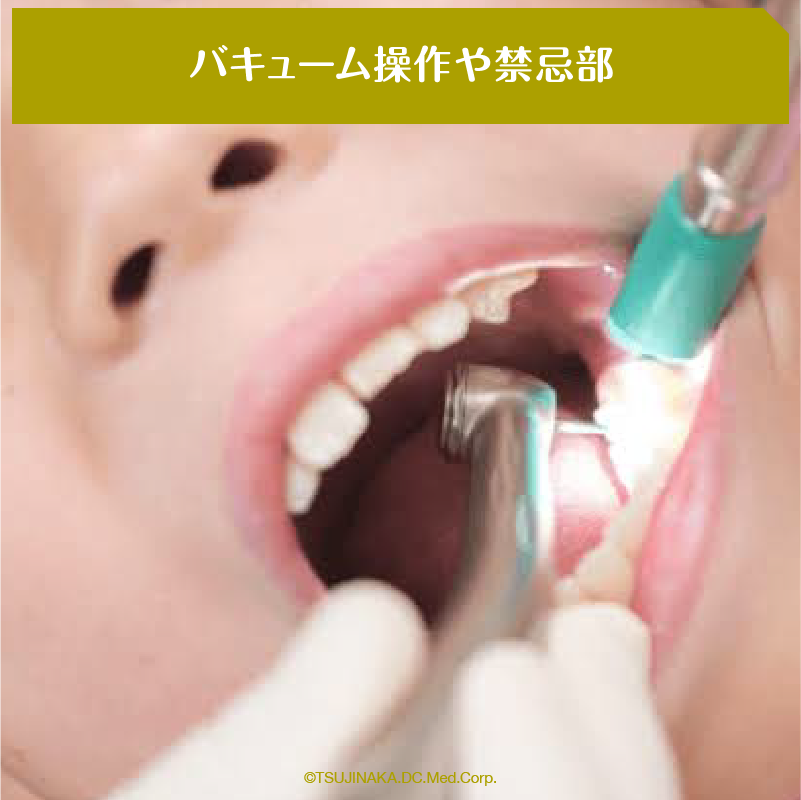 バキューム操作や禁忌部