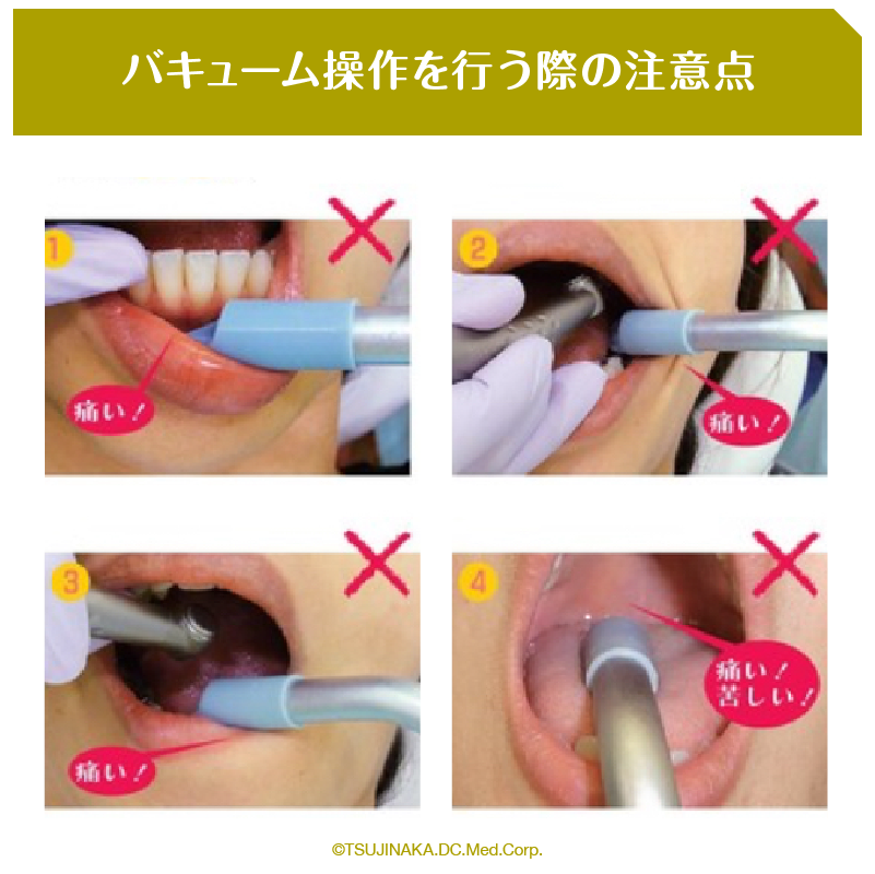 バキューム操作を行う際の注意点