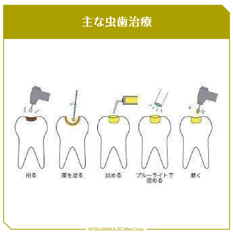 主な虫歯治療