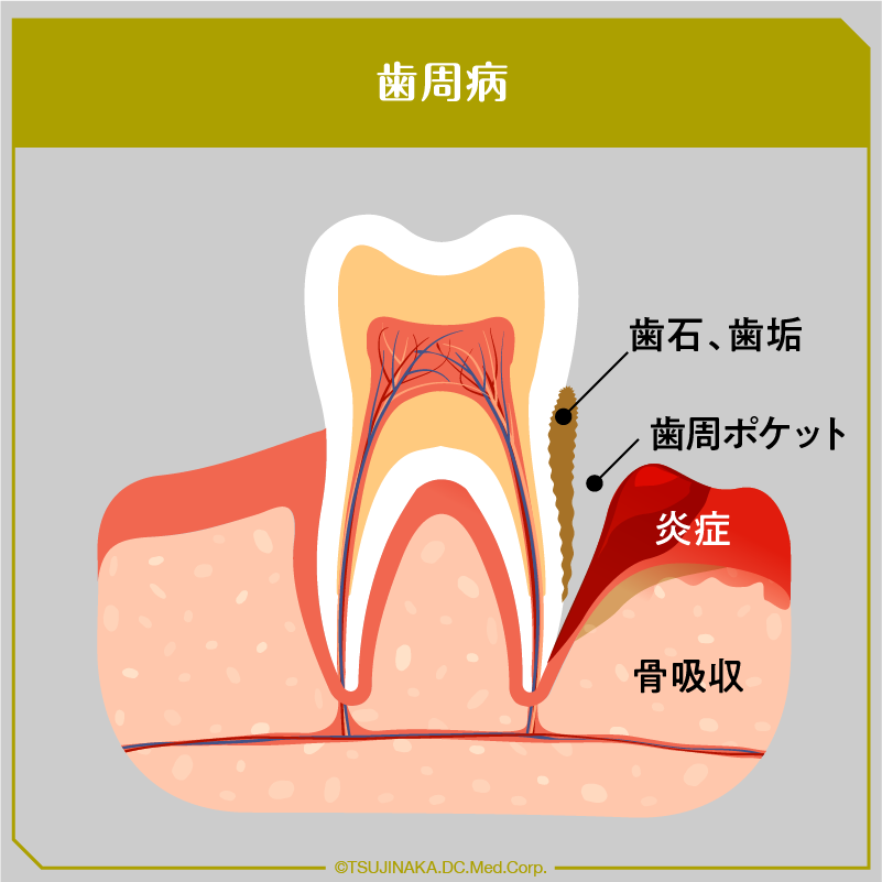 歯周病