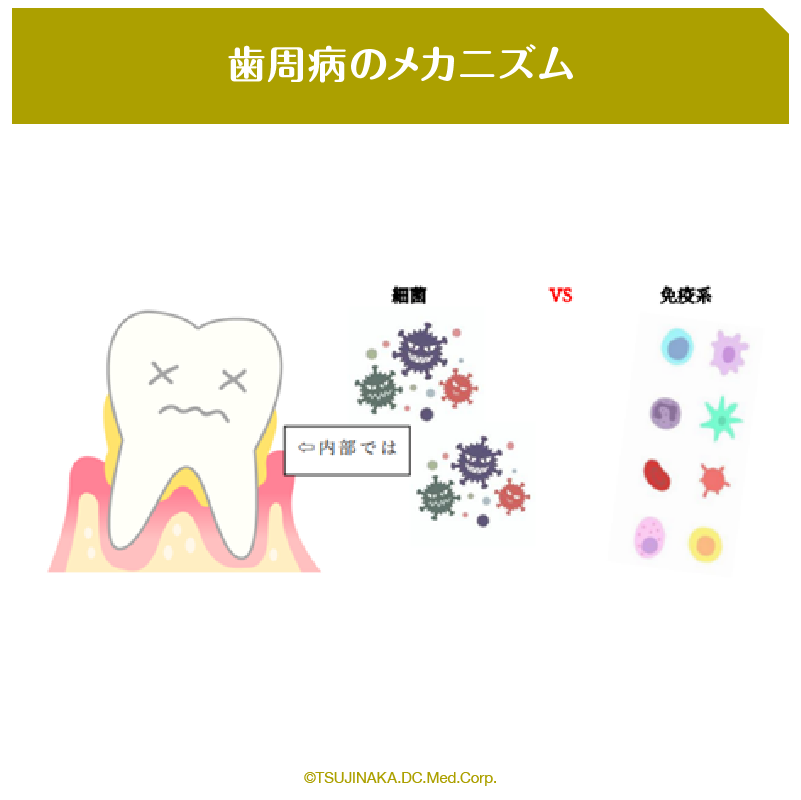 歯周病のメカニズム