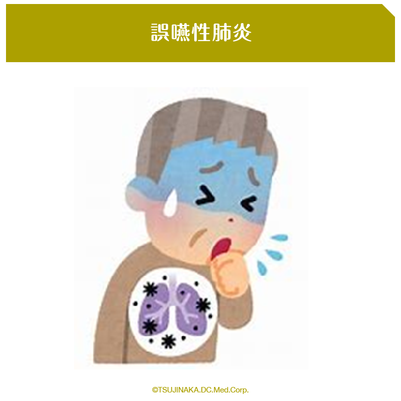 誤嚥性肺炎