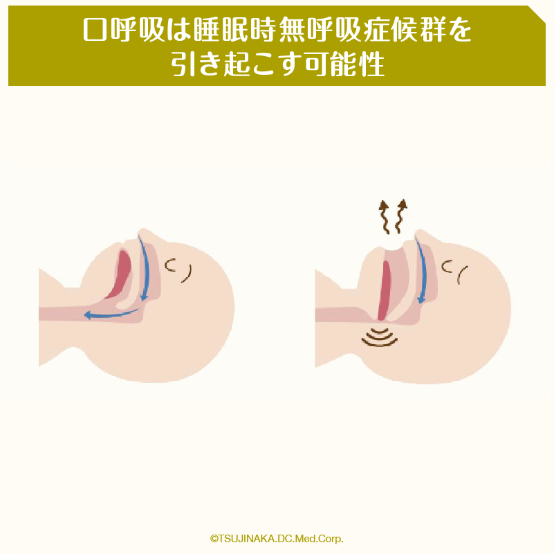 口呼吸は睡眠時無呼吸症候群を引き起こす可能性