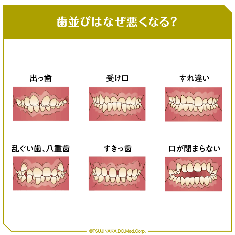 歯並びはなぜ悪くなる？