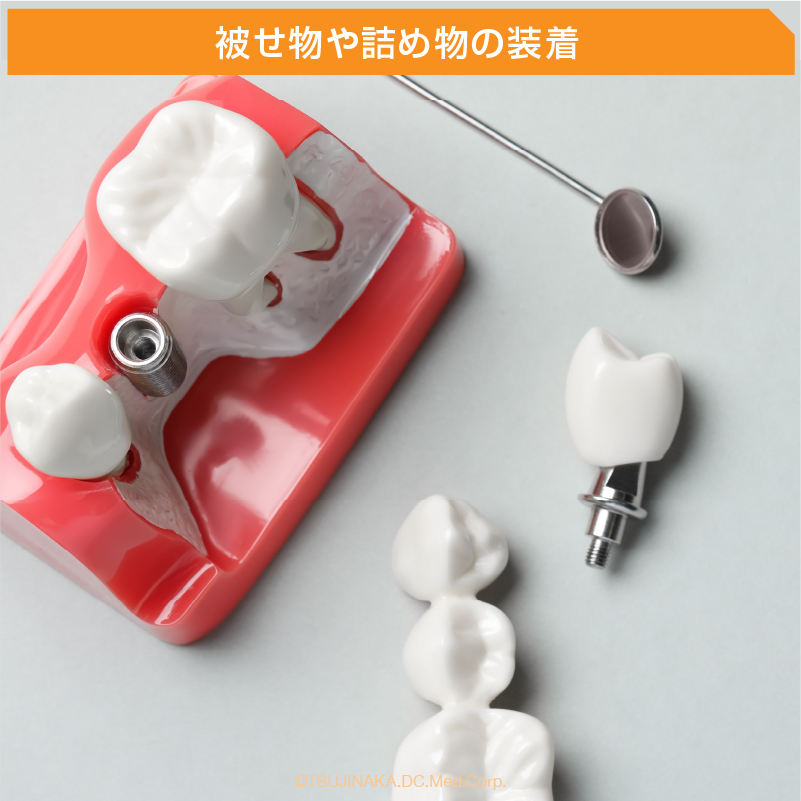 被せ物や詰め物の装着