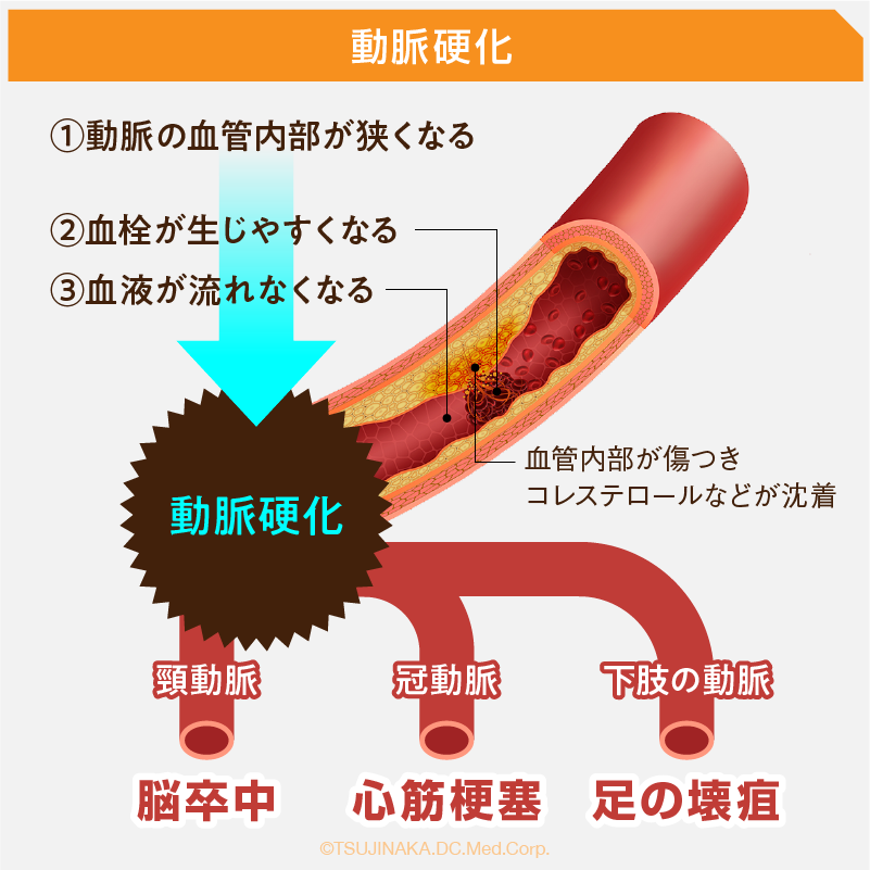 動脈硬化
