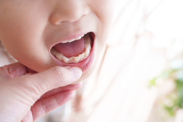 ガタガタで矯正したほうがいい子どもの歯並び