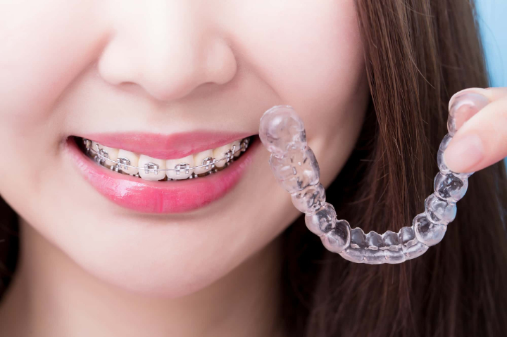 受け口を矯正する方法としてのワイヤー矯正とマウスピース矯正のイメージ