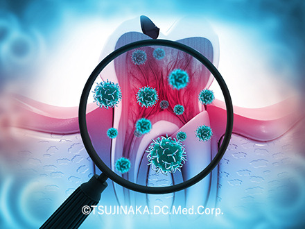 虫歯の原因と進行