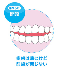 開咬