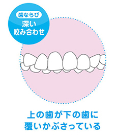 深い噛み合わせ