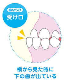 受け口