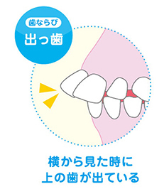 デッパ