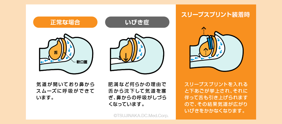 いびきマウスピース