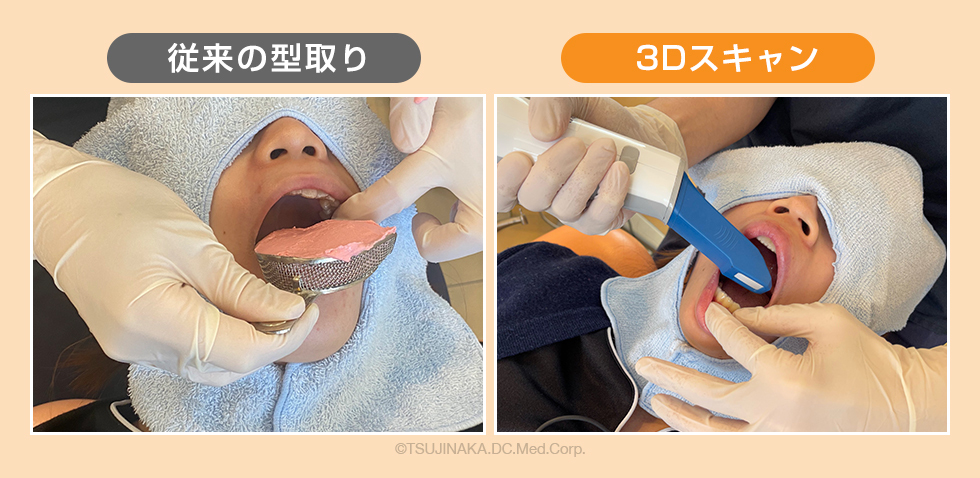 型取り比較