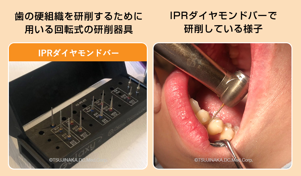 IPRダイヤモンドバーで研削