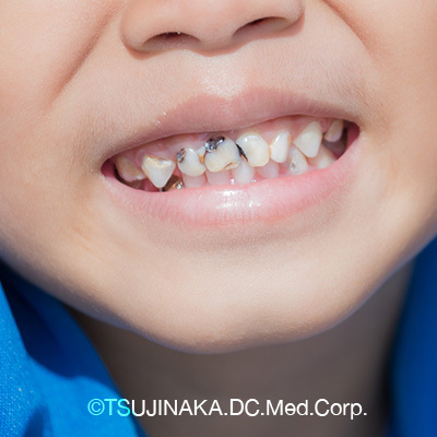 子どもの予防歯科を心がけましょう