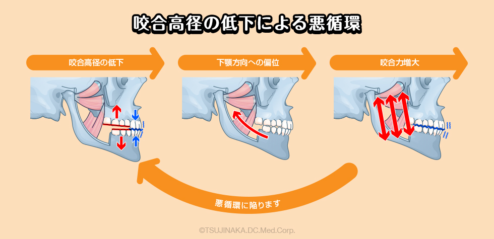 咬合高径の低下による悪循環