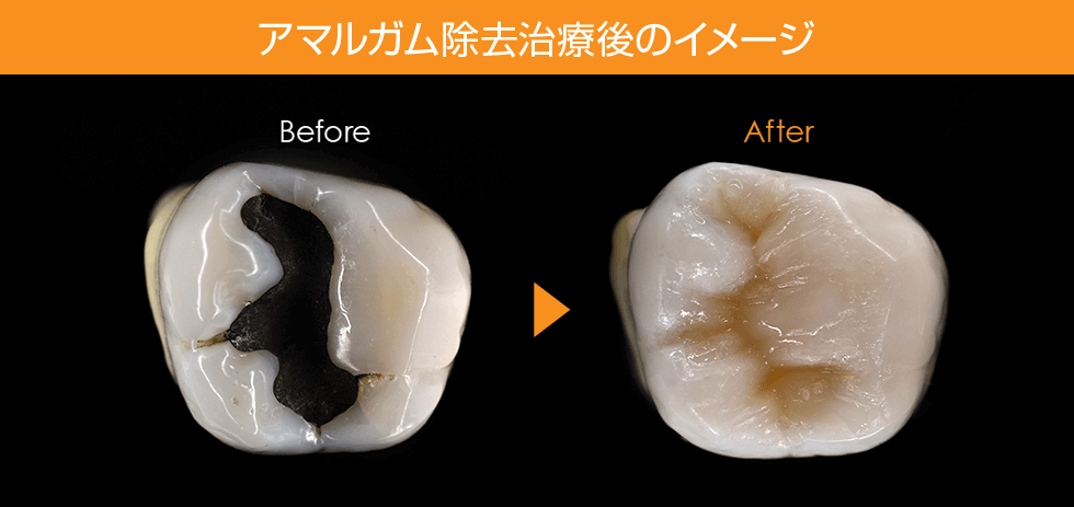 アマルガム除去治療後のイメージ