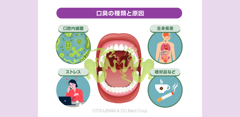 口臭の種類と原因