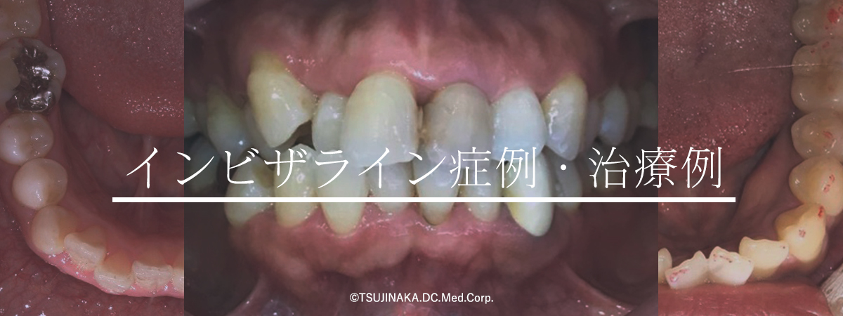 インビザライン症例・治療例