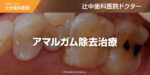 アマルガム除去治療