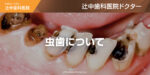 虫歯について