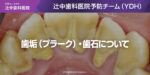 歯垢（プラーク）・歯石について