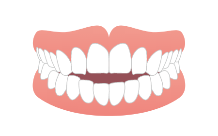 オープンバイト